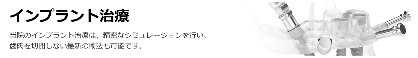 インプラント治療／インプラント治療は精密なシュミレーションを行うガイディッドサージェリーによる治療も対応しています