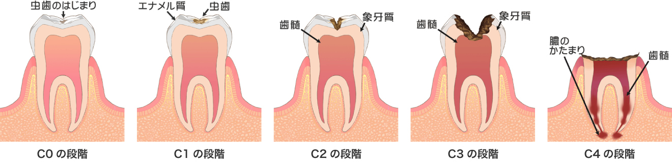 むし歯の進行