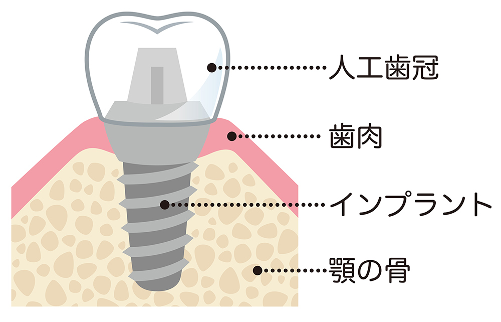 インプラント