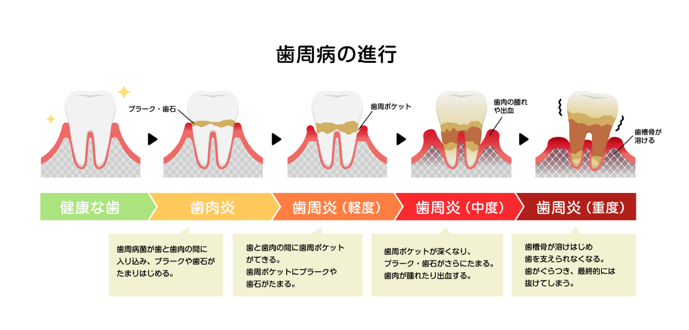 歯周病の進行