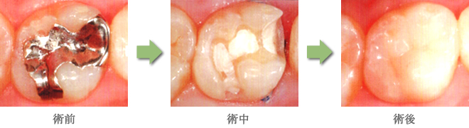 セラミックの詰め物