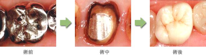セラミックの被せ物