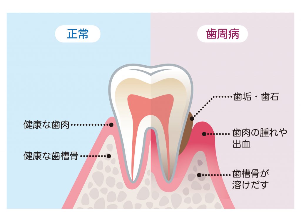 正常の歯と歯周病との比較