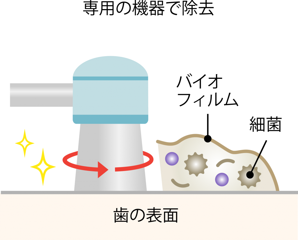 歯のクリー二ングPMTC専用機器で歯石など除去